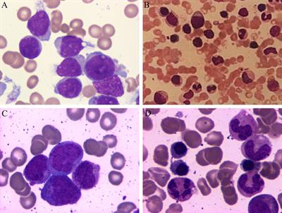 Atorvastatin Plus Low-Dose Dexamethasone May Be Effective for Leukemia-Related Chronic Subdural Hematoma but Not for Leukemia Encephalopathy: A Report of Three Cases